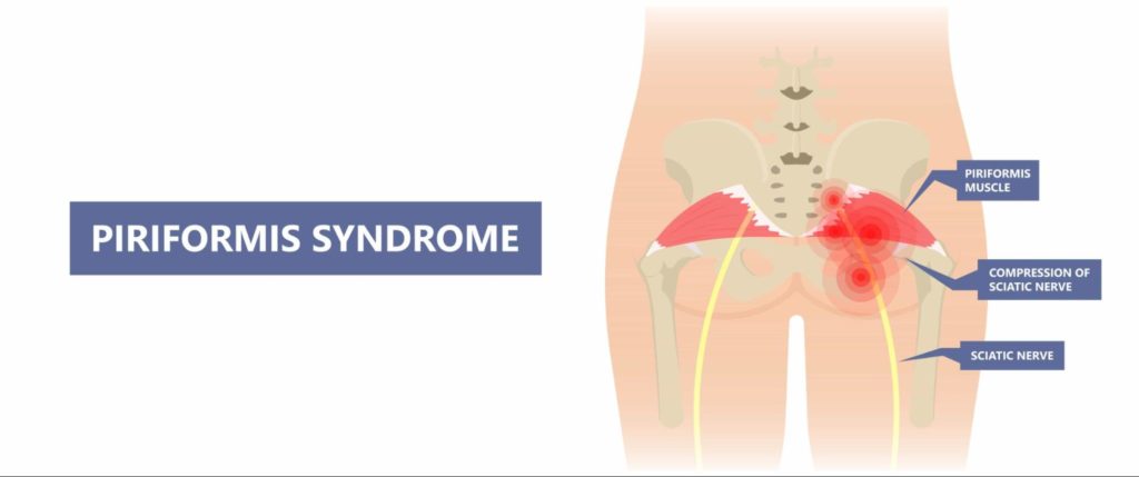 how-to-fix-a-pinched-nerve-in-the-lower-back-piriformis